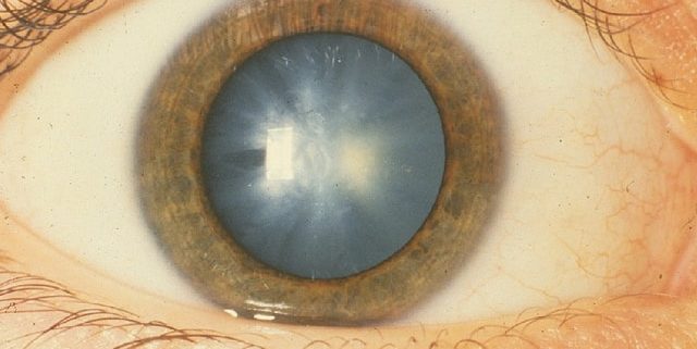 Eye with cataracts